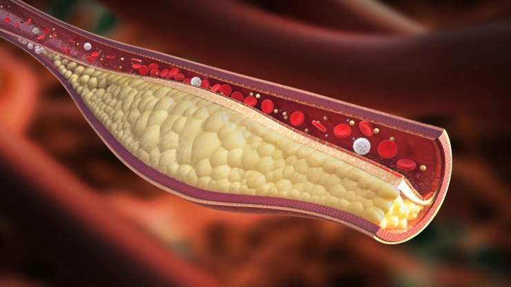 Arteria ostruita dal colesterolo