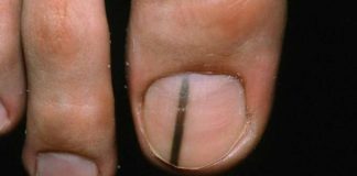 unghie melanoma segni